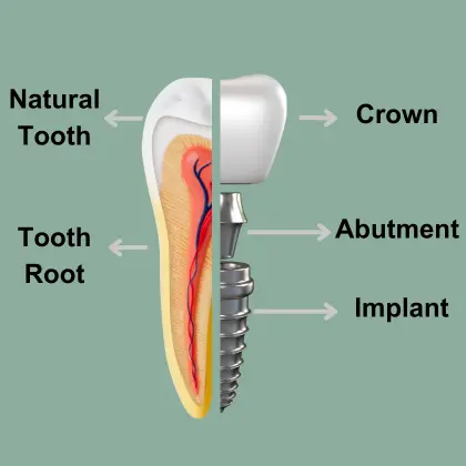 Dental implant Dental implant Izmir